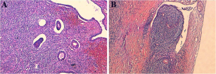 Extra-uterine low grade endometrioid stromal sarcoma arising from ovarian endometriosis: a case report and review of the literature.