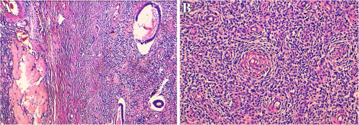 Extra-uterine low grade endometrioid stromal sarcoma arising from ovarian endometriosis: a case report and review of the literature.