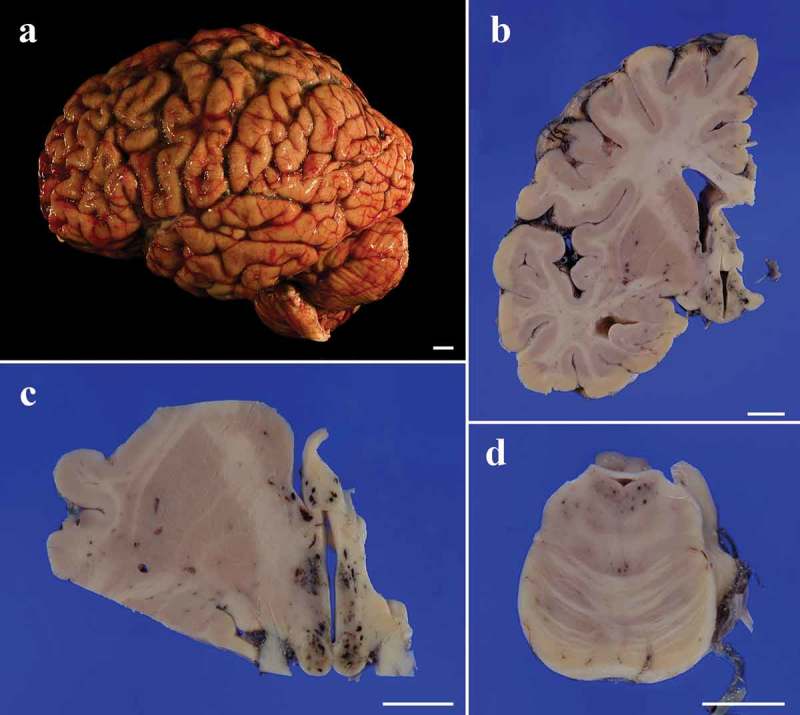 An autopsied case of MM1-type sporadic Creutzfeldt-Jakob disease with pathology of Wernicke encephalopathy.