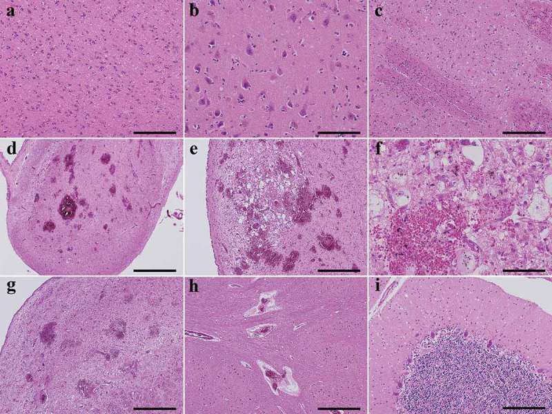 An autopsied case of MM1-type sporadic Creutzfeldt-Jakob disease with pathology of Wernicke encephalopathy.