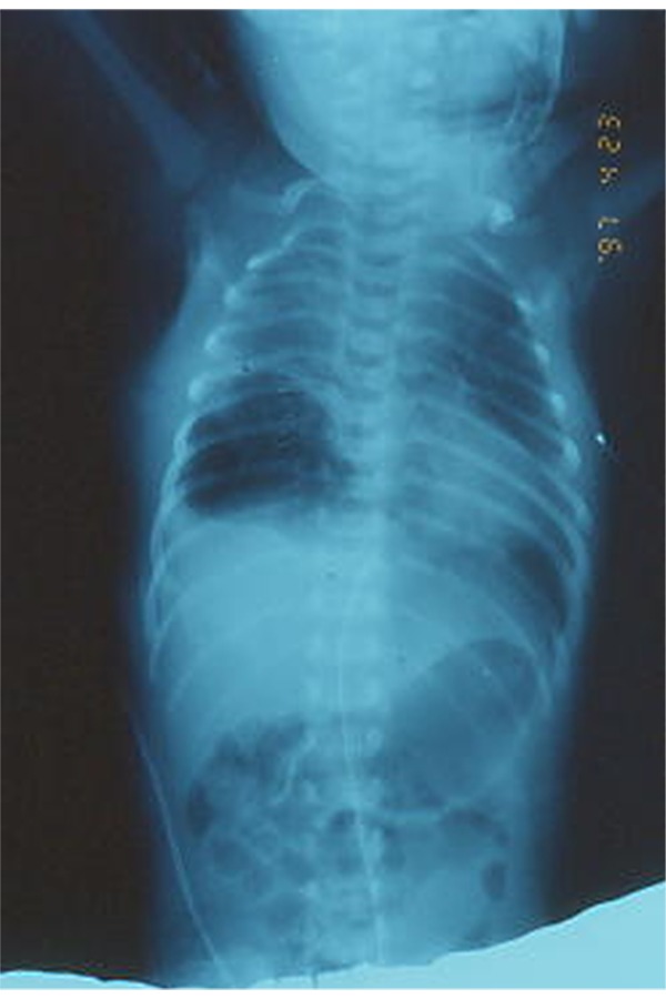 Congenital Cystic Adenomatoid Malformation of the Lung Tipe II: Three Cases Report.