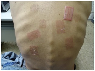 Allergic Contact Dermatitis to Fentanyl TTS with Good Tolerance to Systemic Fentanyl.