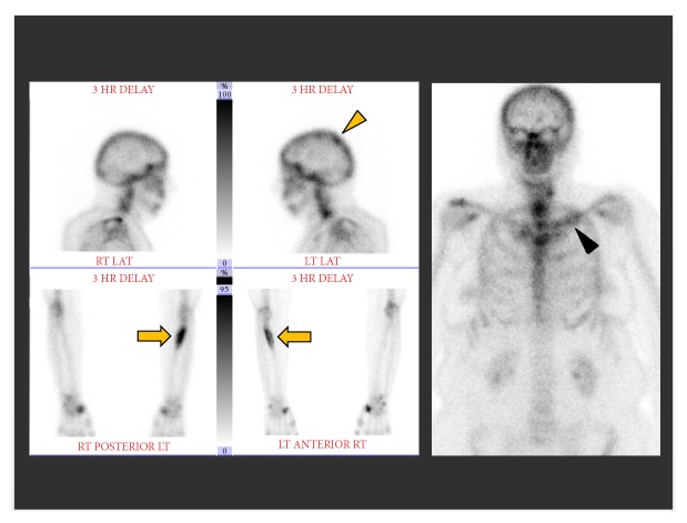 Primary Rosai-Dorfman Disease of Bone: A Report of Two Cases.