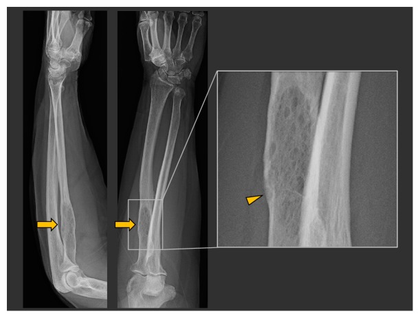 Primary Rosai-Dorfman Disease of Bone: A Report of Two Cases.