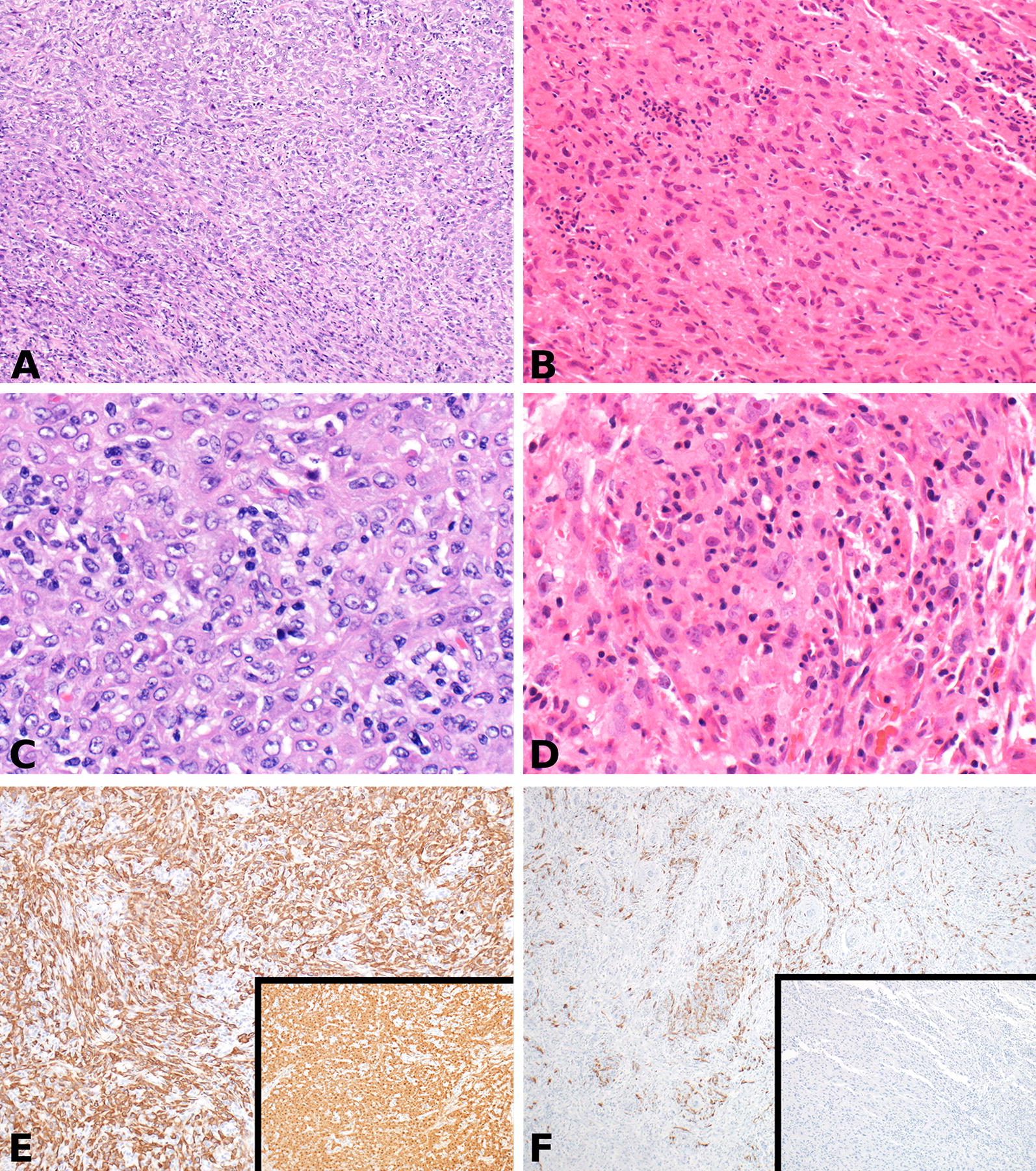 Long-term cure of soft tissue sarcoma with pegylated-liposomal doxorubicin after doxorubicin and ifosfamide failure.