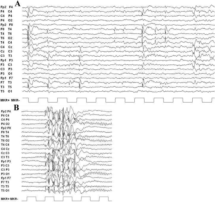 Epilepsy phenotype in patients with Xp22.31 microduplication