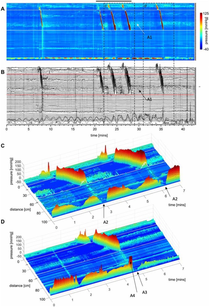 Recent advances in intestinal smooth muscle research: from muscle strips and single cells, via ICC networks to whole organ physiology and assessment of human gut motor dysfunction.