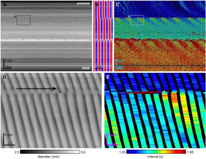 Recent advances in intestinal smooth muscle research: from muscle strips and single cells, via ICC networks to whole organ physiology and assessment of human gut motor dysfunction.