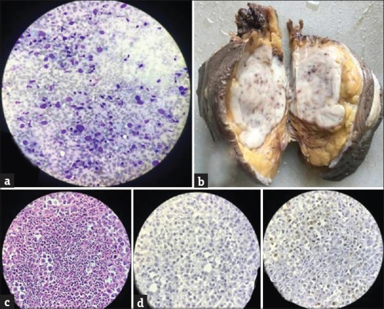 Rare Breast Malignancy Subtypes: A Cytological, Histological, and Immunohistochemical Correlation.