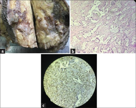 Rare Breast Malignancy Subtypes: A Cytological, Histological, and Immunohistochemical Correlation.
