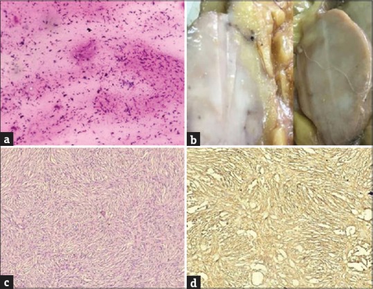 Rare Breast Malignancy Subtypes: A Cytological, Histological, and Immunohistochemical Correlation.