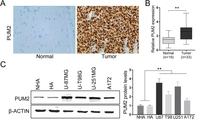 PUM2 Promotes Glioblastoma Cell Proliferation and Migration via Repressing BTG1 Expression.