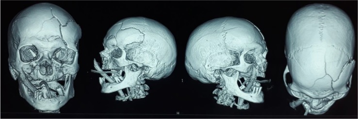 Animal Injuries; a Case Series of Bull Induced Injuries in India.