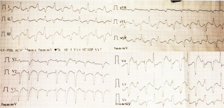 Bidirectional Ventricular Tachycardia in a Women with Dilated Cardiomyopathy: A Case Report.