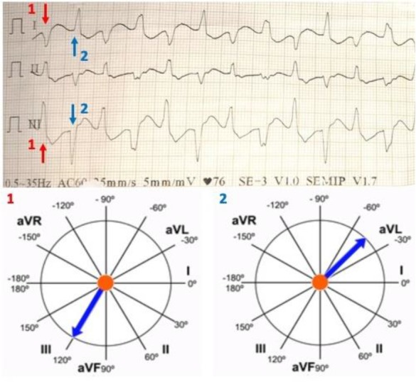 Bidirectional Ventricular Tachycardia in a Women with Dilated Cardiomyopathy: A Case Report.