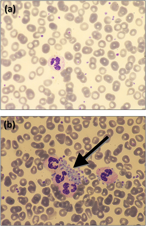 An unusual case of sodium citrate-dependent artifactual platelet count.