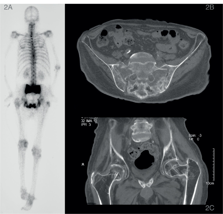 Sacral Insufficiency Fractures in Patients with Spinal Cord Injury: A Report of Two Unusual Cases and Review of Literature.