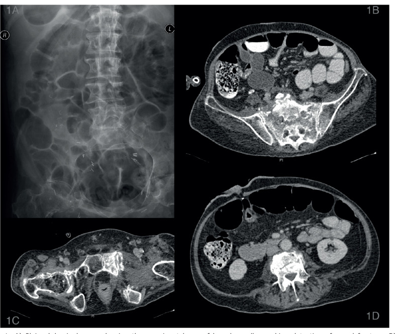 Sacral Insufficiency Fractures in Patients with Spinal Cord Injury: A Report of Two Unusual Cases and Review of Literature.