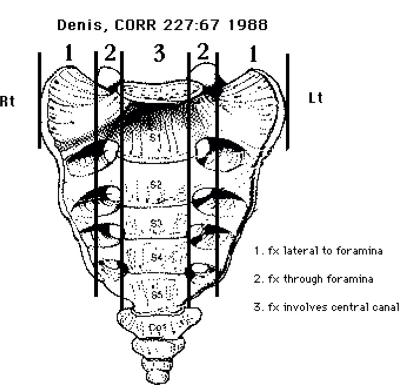 Sacral Insufficiency Fractures in Patients with Spinal Cord Injury: A Report of Two Unusual Cases and Review of Literature.