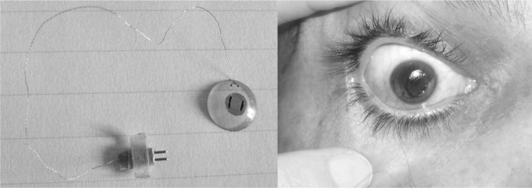 Advances in diagnostic applications for monitoring intraocular pressure in Glaucoma: A review.