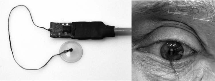 Advances in diagnostic applications for monitoring intraocular pressure in Glaucoma: A review.