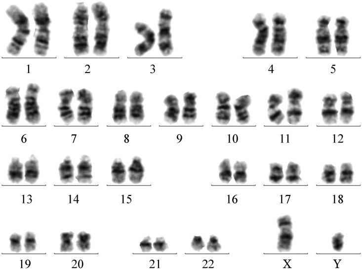 [Cytogenetic test and clinical study on cryptic acute promyelocytic leukemia with ins (15; 17)].