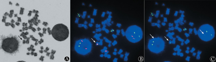 [Cytogenetic test and clinical study on cryptic acute promyelocytic leukemia with ins (15; 17)].