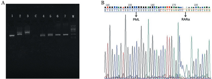 [Cytogenetic test and clinical study on cryptic acute promyelocytic leukemia with ins (15; 17)].