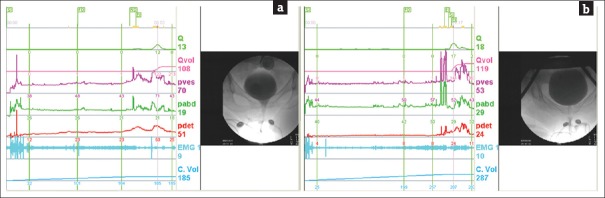 Role of videourodynamic study in precision diagnosis and treatment for lower urinary tract dysfunction.