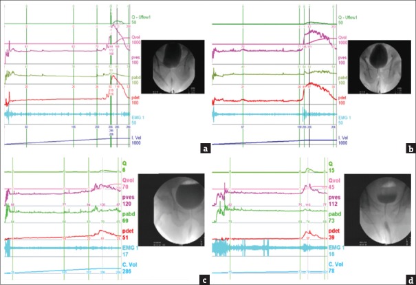 Role of videourodynamic study in precision diagnosis and treatment for lower urinary tract dysfunction.