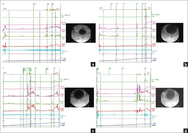 Role of videourodynamic study in precision diagnosis and treatment for lower urinary tract dysfunction.