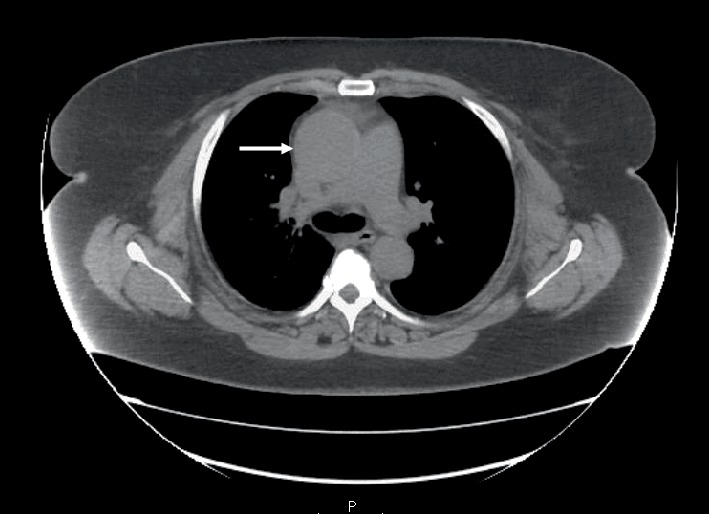 A Case of Aortic Dissection Presenting with Atypical Symptoms and Diagnosed with Transthoracic Echocardiography.