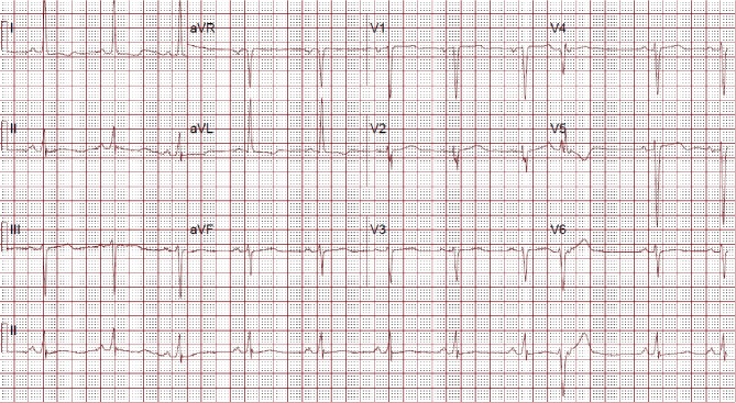 A Case of Aortic Dissection Presenting with Atypical Symptoms and Diagnosed with Transthoracic Echocardiography.