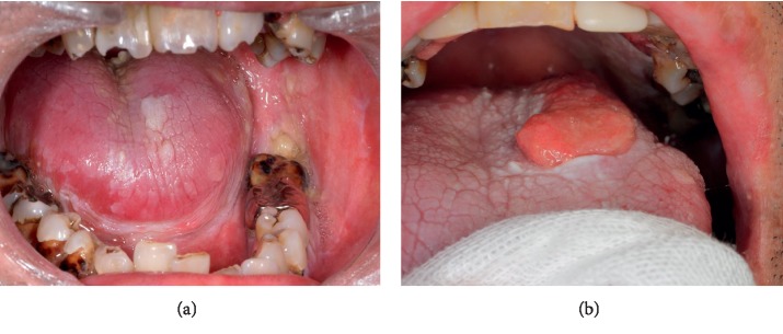 Secondary Squamous Cell Carcinoma of the Tongue Complicated with Bronchiolitis Obliterans as a Manifestation of Graft-versus-Host Disease following Peripheral Blood Stem Cell Transplantation.