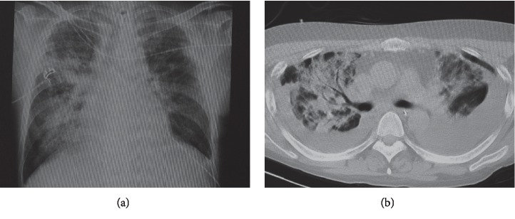 Secondary Squamous Cell Carcinoma of the Tongue Complicated with Bronchiolitis Obliterans as a Manifestation of Graft-versus-Host Disease following Peripheral Blood Stem Cell Transplantation.