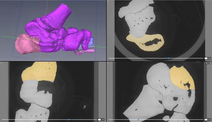 Visualization of a Juvenile Australopithecus afarensis Specimen: Implications for Functional Foot Anatomy.