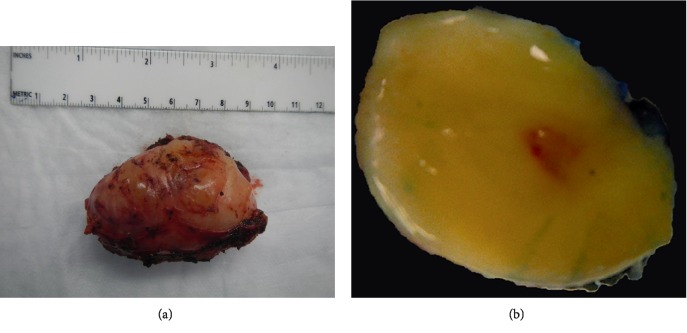 A Case of Isolated Primary Pleural Neurofibroma in a 39-Year-Old Woman.