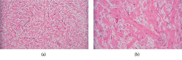 A Case of Isolated Primary Pleural Neurofibroma in a 39-Year-Old Woman.