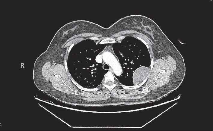 A Case of Isolated Primary Pleural Neurofibroma in a 39-Year-Old Woman.