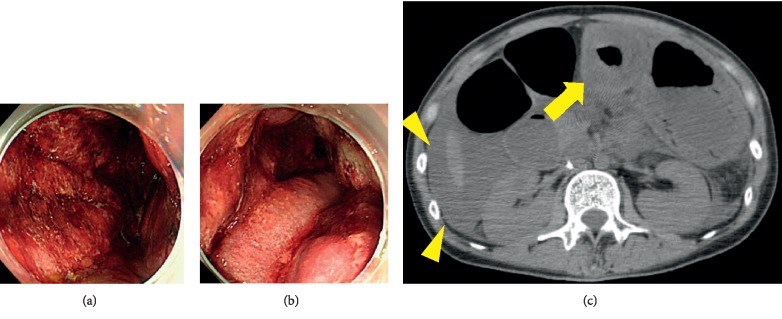 Prolonged Myelosuppression due to Progressive Bone Marrow Fibrosis in a Patient with Acute Promyelocytic Leukemia.