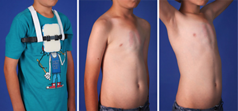 Professional Clinical Photography to Assist Patients with Pectus Carinatum.