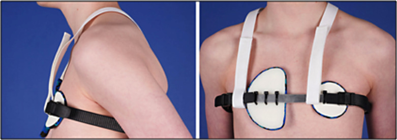 Professional Clinical Photography to Assist Patients with Pectus Carinatum.