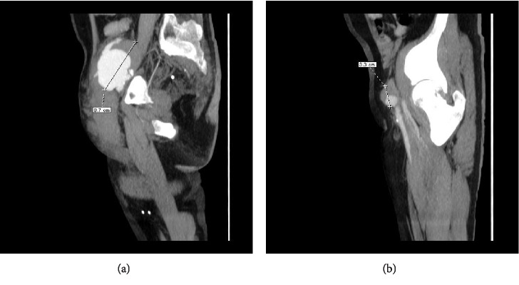 Massive Scrotal Hematoma due to Ruptured Anastomotic Pseudoaneurysm in a Patient with Aortobifemoral Bypass Surgery: CTA Evaluation.