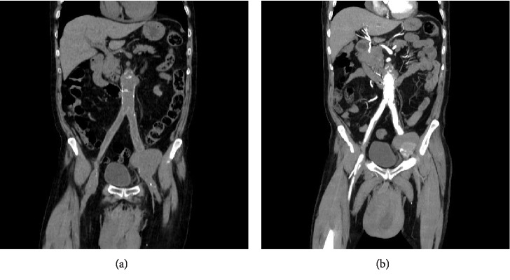 Massive Scrotal Hematoma due to Ruptured Anastomotic Pseudoaneurysm in a Patient with Aortobifemoral Bypass Surgery: CTA Evaluation.