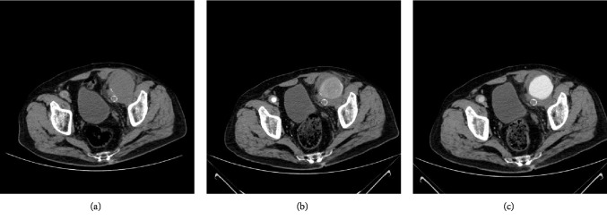 Massive Scrotal Hematoma due to Ruptured Anastomotic Pseudoaneurysm in a Patient with Aortobifemoral Bypass Surgery: CTA Evaluation.