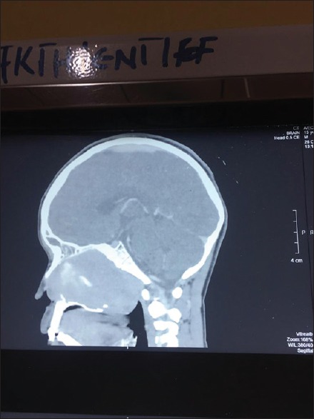 Encapsulated Sinonasal Schwannoma Mimicking an Antrochoanal Polyp.