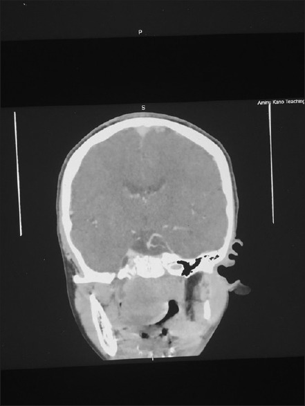 Encapsulated Sinonasal Schwannoma Mimicking an Antrochoanal Polyp.