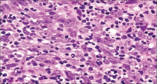 The Role of a Minimum Immunohistochemical Antibody Panel in Confirming Undifferentiated Nasopharyngeal Carcinoma: A Cross-Sectional Study at the Muhimbili National Hospital, Dar-es-Salaam, Tanzania.