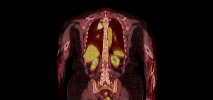 Solitary Pulmonary Nodule: A Diagnostic Dilemma.