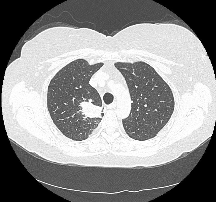 Solitary Pulmonary Nodule: A Diagnostic Dilemma.